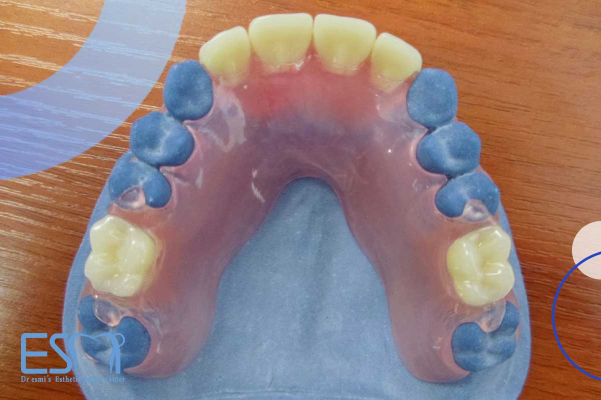 چرا فرد نیاز به دندان مصنوعی پارسیل  دارد؟