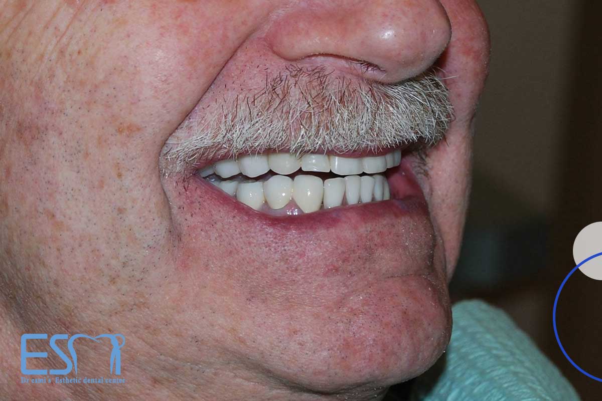 مزایای استفاده از دندان مصنوعی: