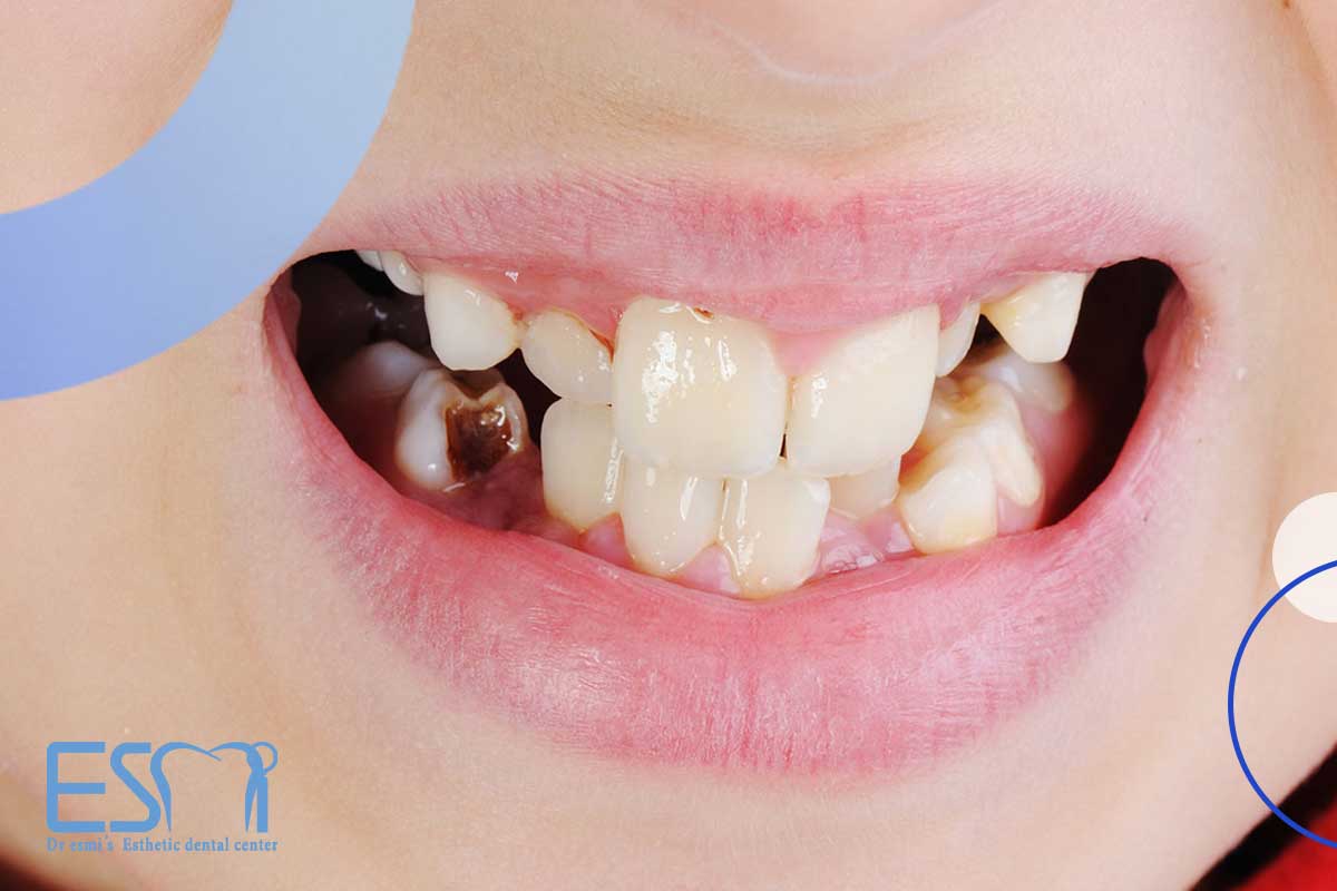 انواع ترمیم دندان کودکان