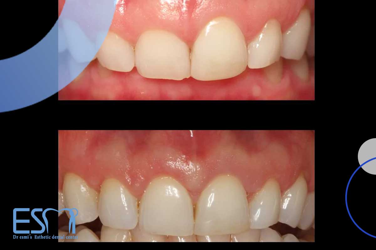 عکس قبل و بعد افزایش طول تاج دندان