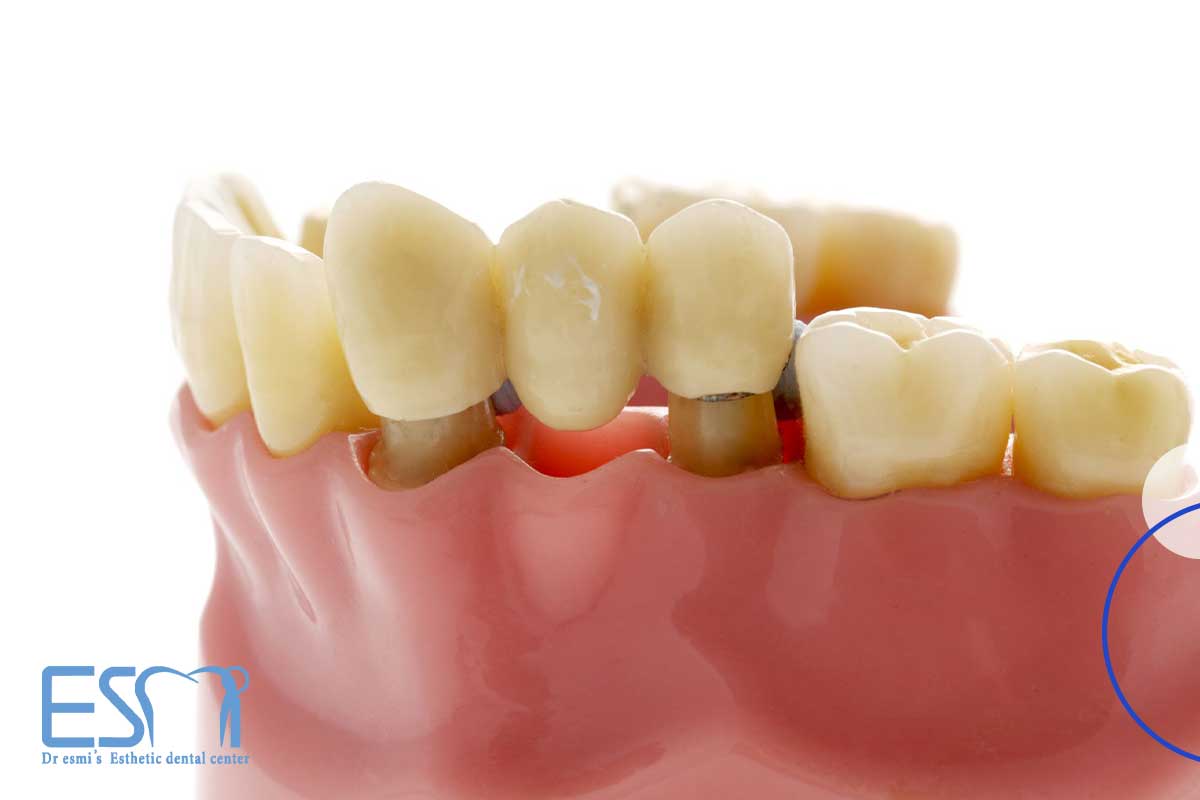 پروتزهای دندان ثابت