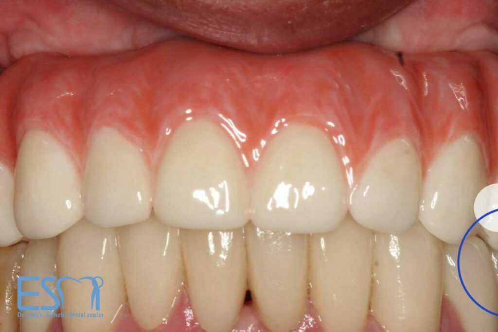 پروتز های ثابت متکی بر دندان