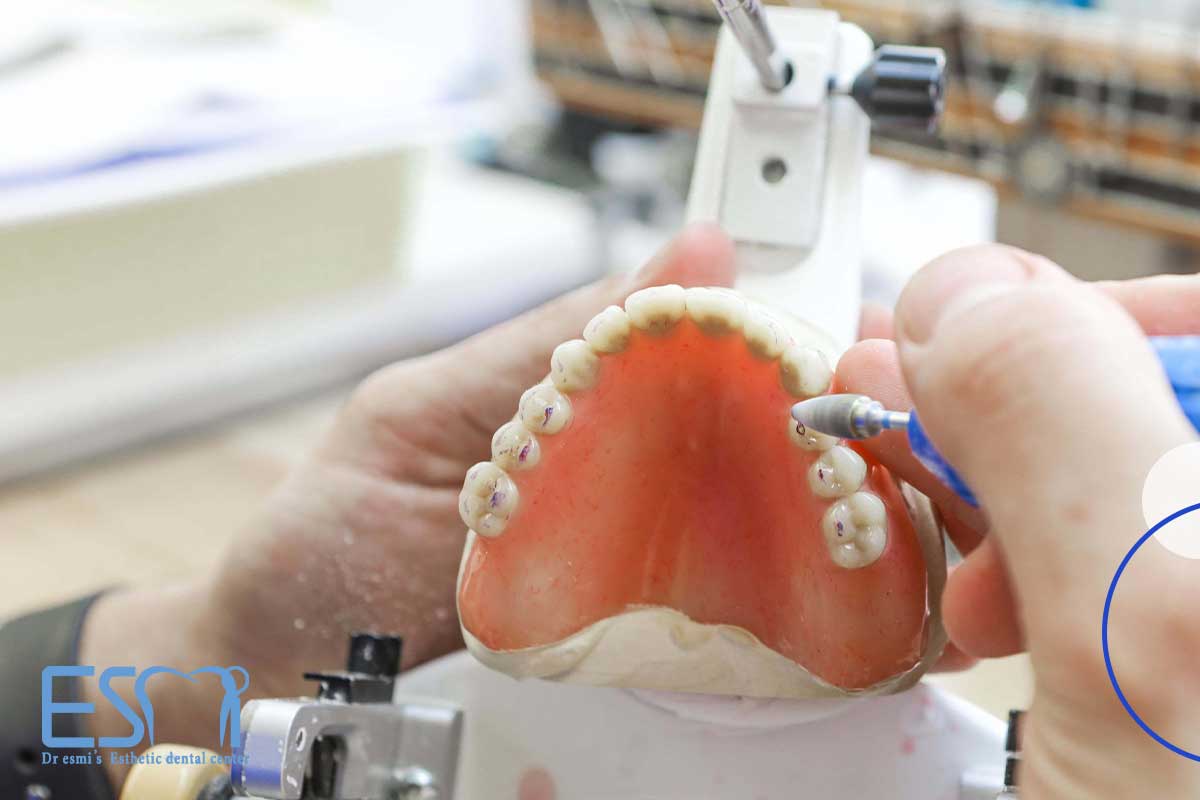 چه زمانی از دندان مصنوعی استفاده می‌شود؟