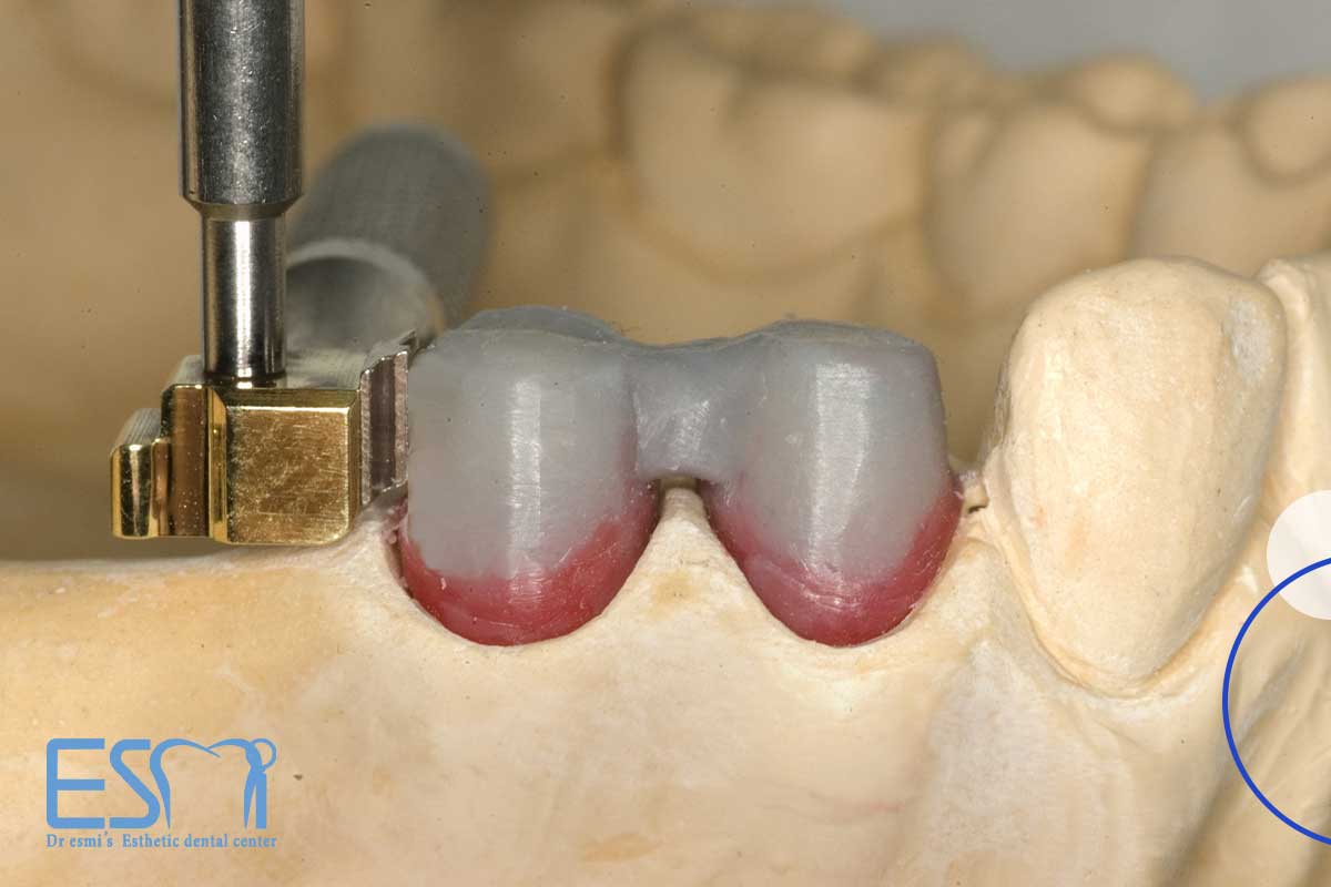پروتزهای دندانی ثابت