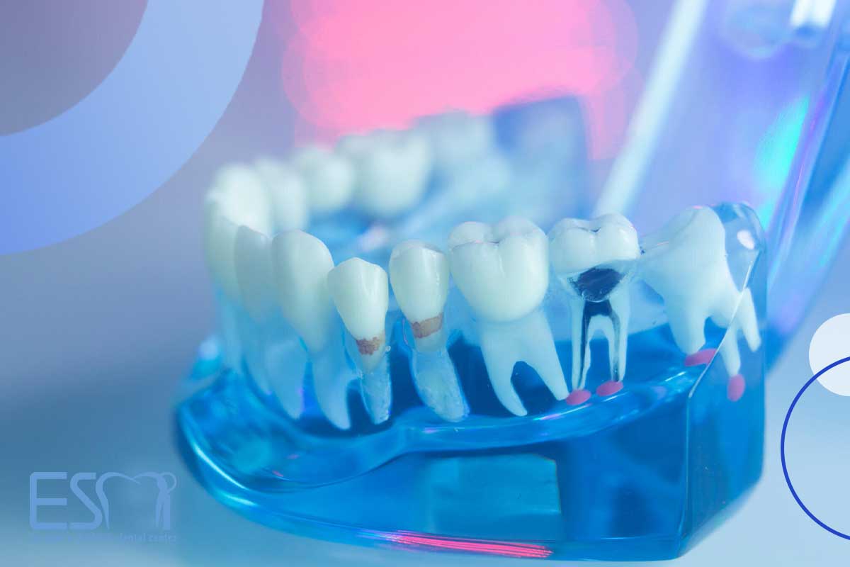 عصب کشی دندان کودکان در دندان های دائمی