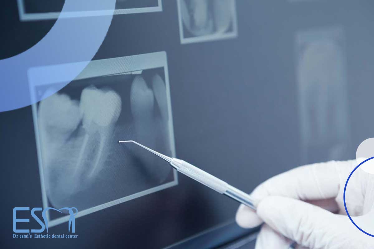 اگر عصب کشی دندان کودکان روی دندان شیری انجام شود، آیا دندان دائمی می‌تواند رشد کند؟