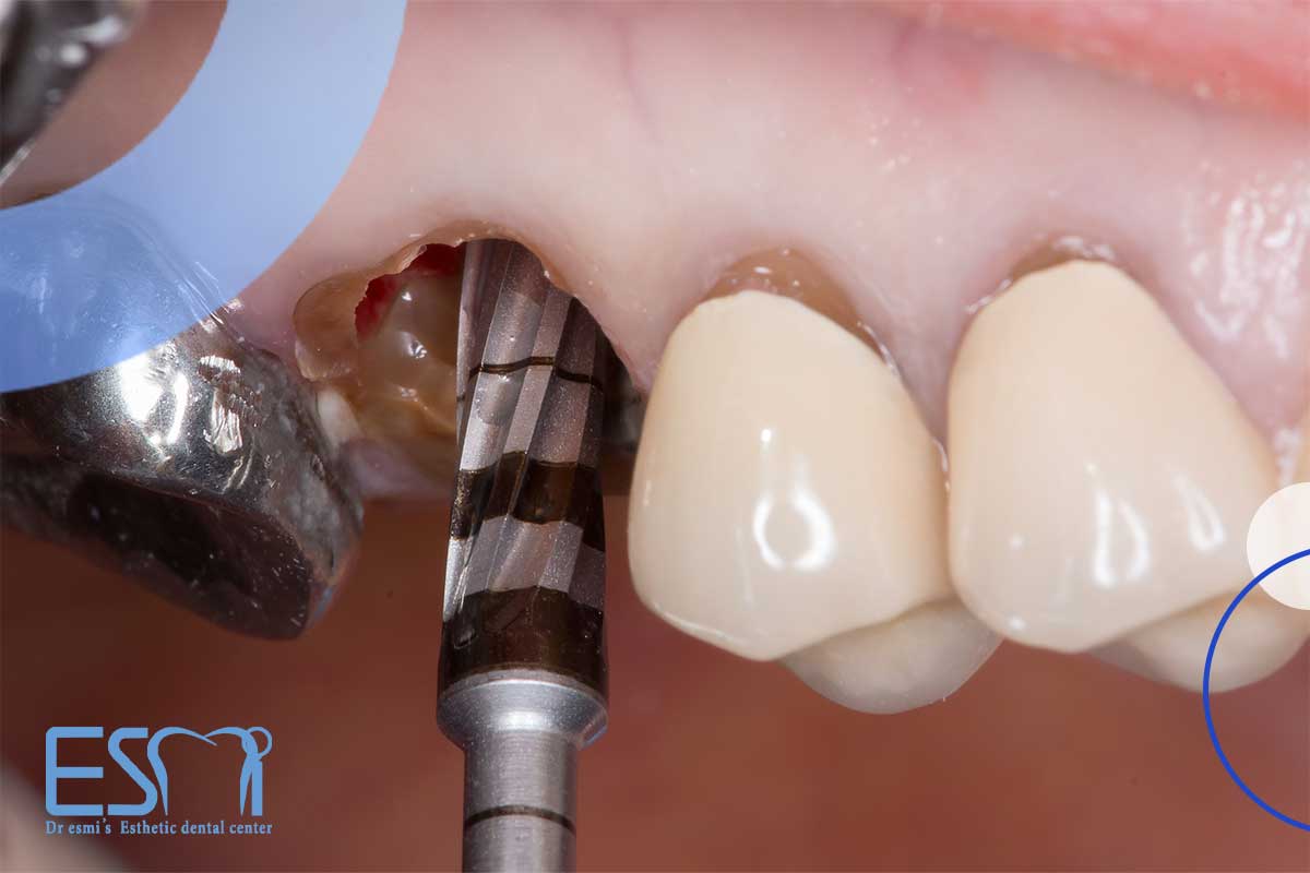 قبل از ایمپلنت دندان باید به یک نکته مهم توجه کرد: