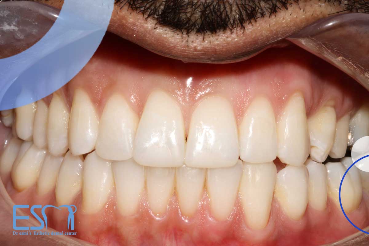 کامپوزیت دندان چگونه ساخته می‌شود؟