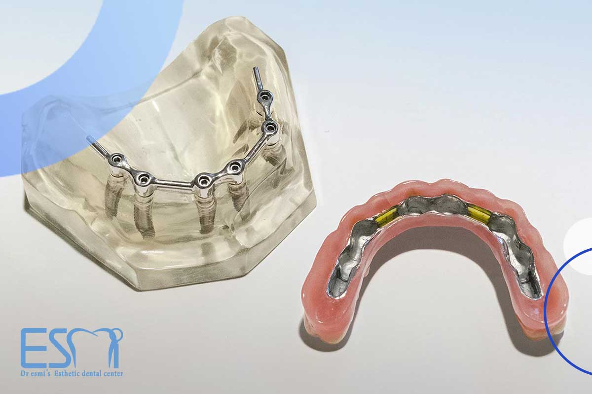چه کسانی نمی‌توانند درمان ایمپلنت دندان انجام دهند؟