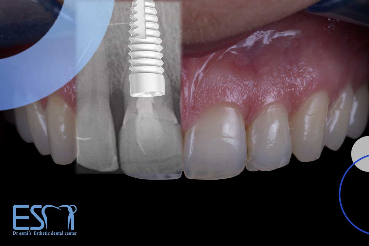 معاینه ایمپلنت دندان شامل چه مراحلی است؟