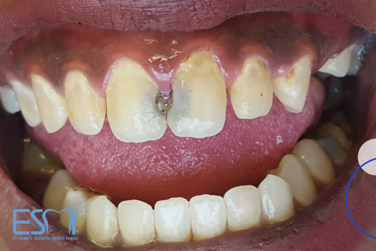  عکس پوسیدگی بین دندان 