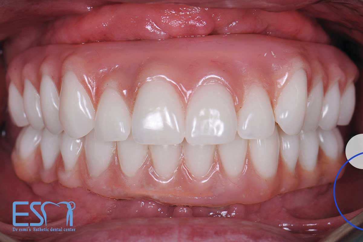درمان درد لثه در اثر فشردن دندان مصنوعی