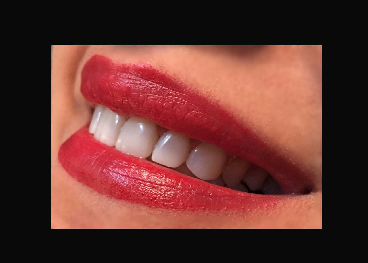 مزایای انتخاب کامپوزیت دندان شمال تهران در کلینیک دندانپزشکی دکتر اسمی
