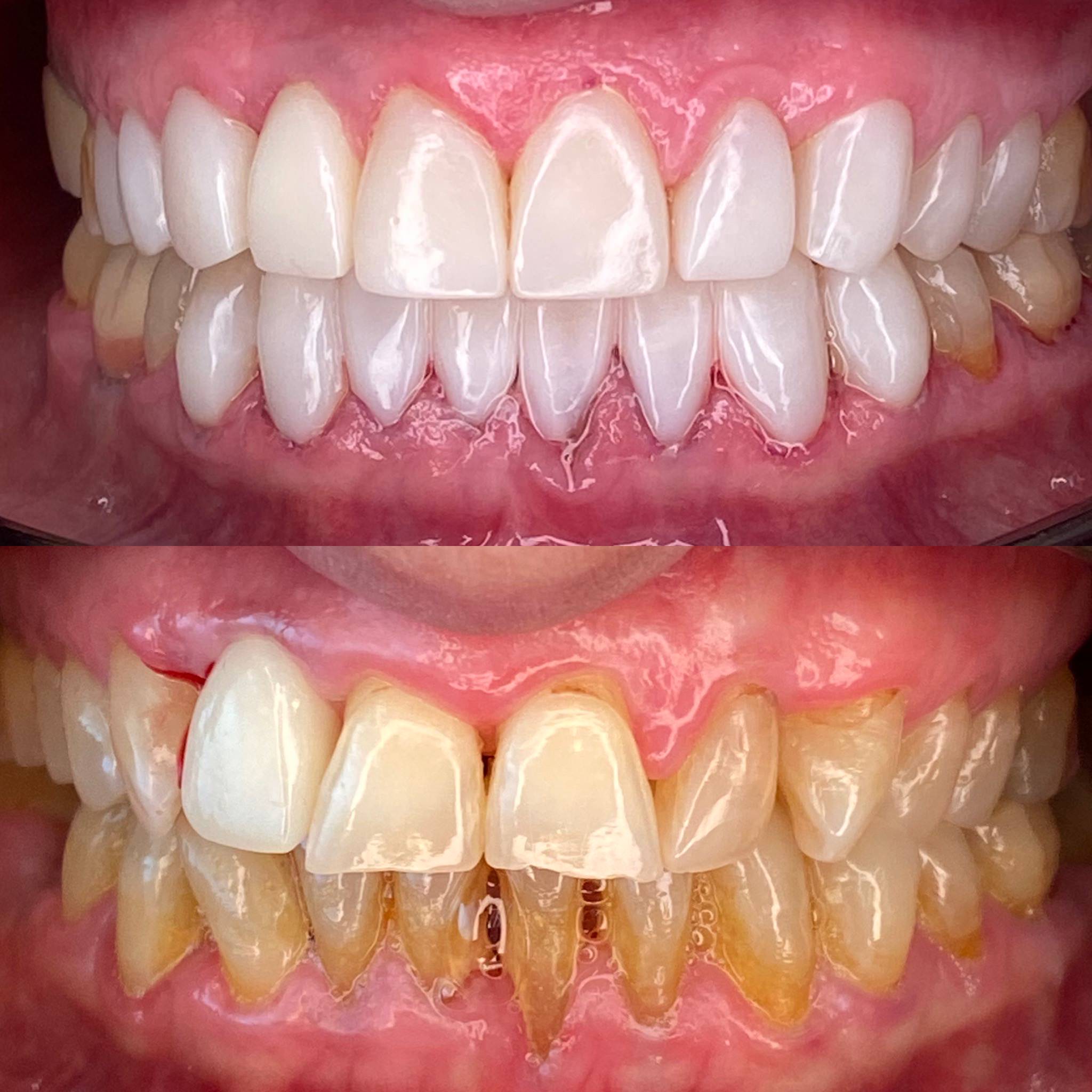 عکس قبل و بعد لمینت دندان در کلینیک دکتر اسمی 