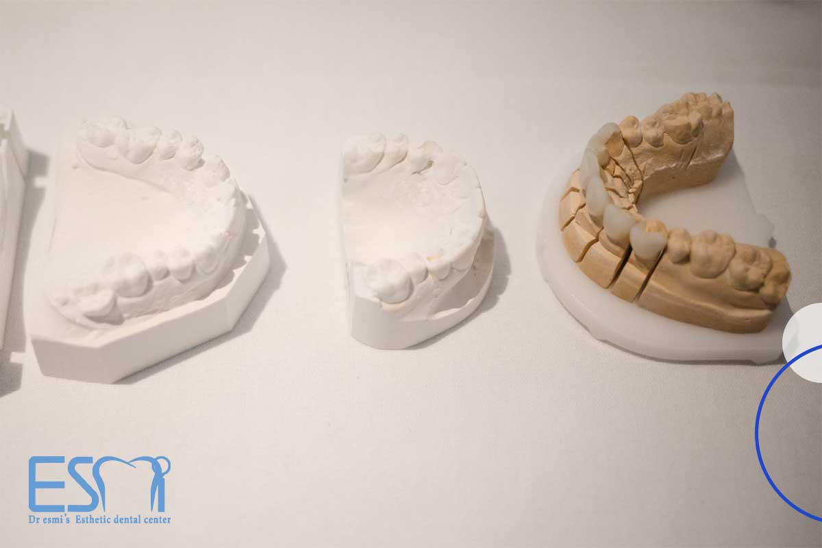 دستورالعمل‌های مراقبت پس از درمان لمینت دندان در مراحل اولیه